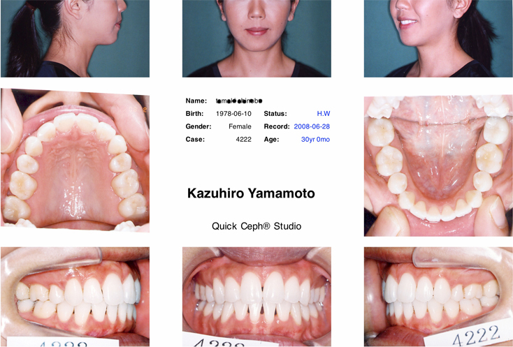 「ハリウッドスマイル症例1)」の鎌倉 dentfaco 予防歯科でのホワイトニング後の写真