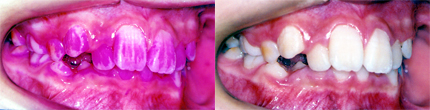 鎌倉 dentfaco 予防歯科:大便の2倍の細菌数のバイオフィルムが歯ブラシ指導できれいになりました！
